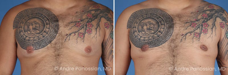 Male Breast Reduction (Gynecomastia) Before & After Gallery - Patient 211270 - Image 1