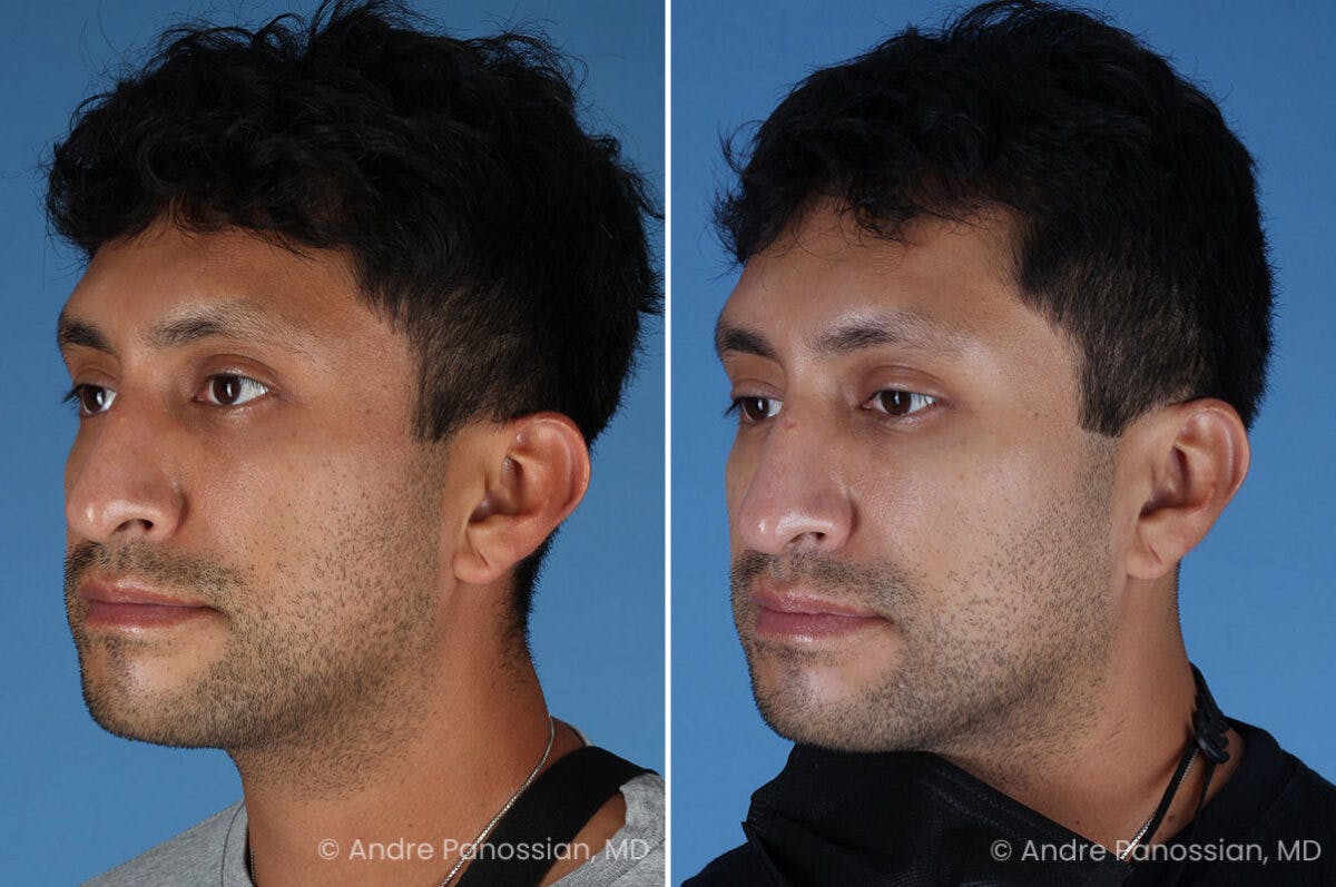 Ear Pinning (Otoplasty) Before & After Gallery - Patient 209648 - Image 4