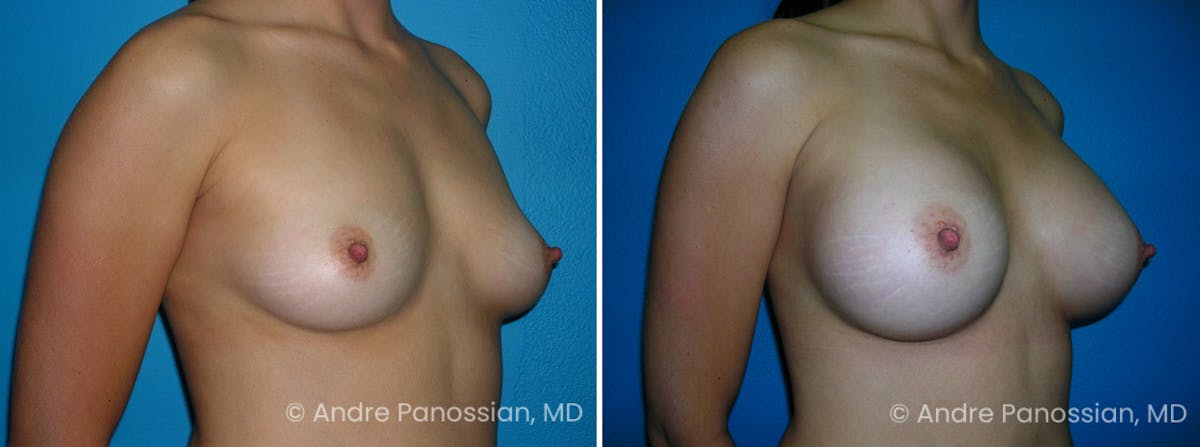 Breast Augmentation Before & After Gallery - Patient 824272 - Image 1