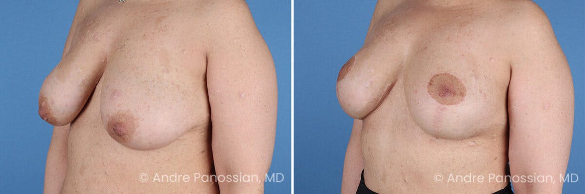 Breast Lift/Reduction Before & After Gallery - Patient 598214 - Image 4