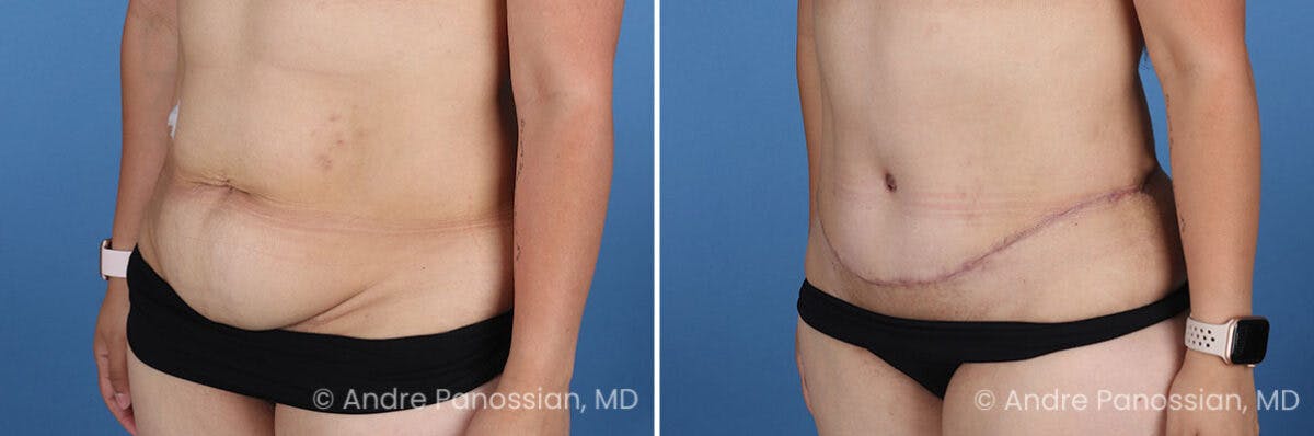 Tummy Tuck Before & After Gallery - Patient 319524 - Image 5