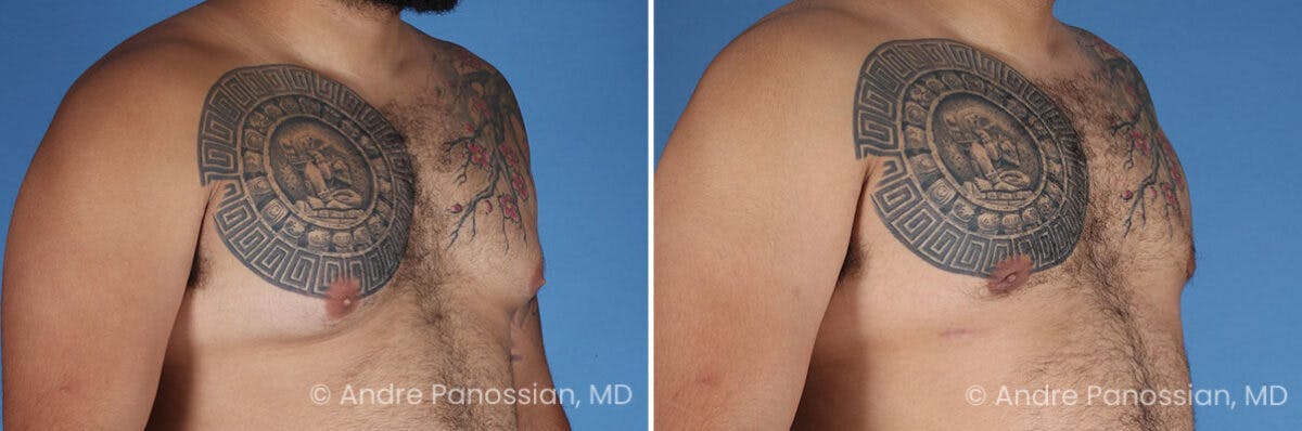 Male Breast Reduction (Gynecomastia) Before & After Gallery - Patient 211270 - Image 2
