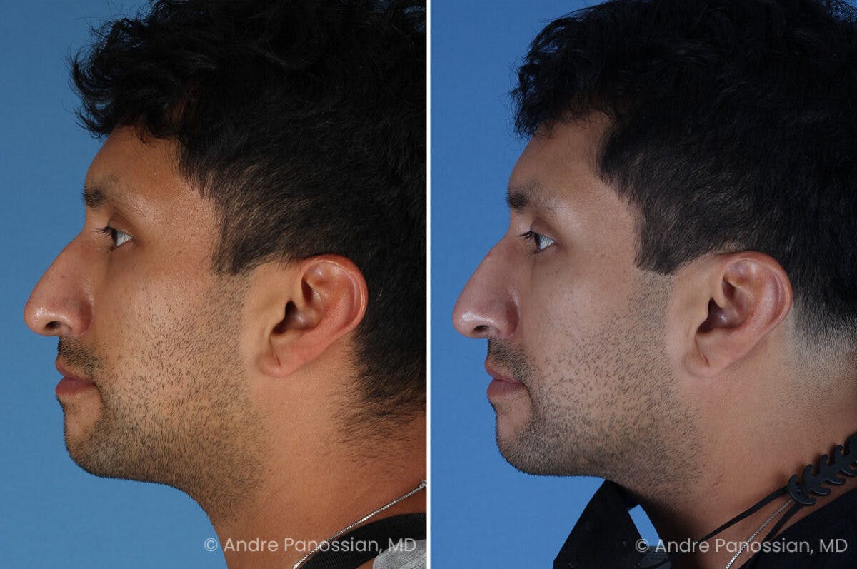 Ear Pinning (Otoplasty) Before & After Gallery - Patient 209648 - Image 5