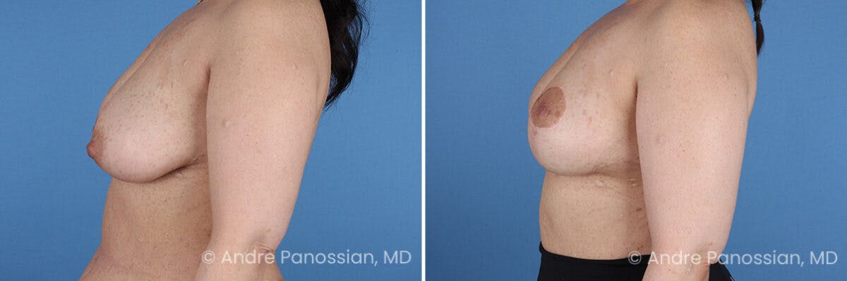 Breast Lift/Reduction Before & After Gallery - Patient 598214 - Image 5