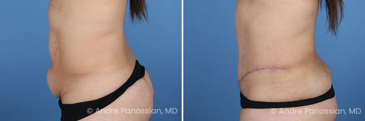 Tummy Tuck Before & After Gallery - Patient 319524 - Image 6