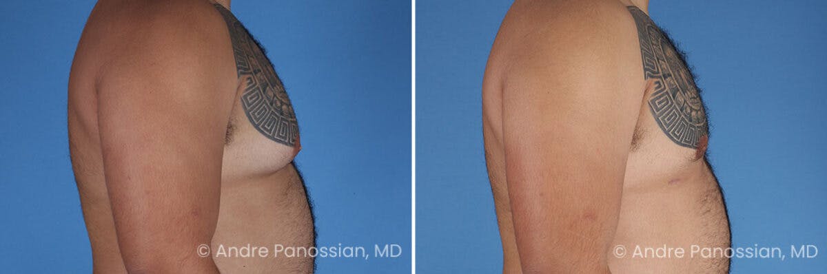 Male Breast Reduction (Gynecomastia) Before & After Gallery - Patient 211270 - Image 3