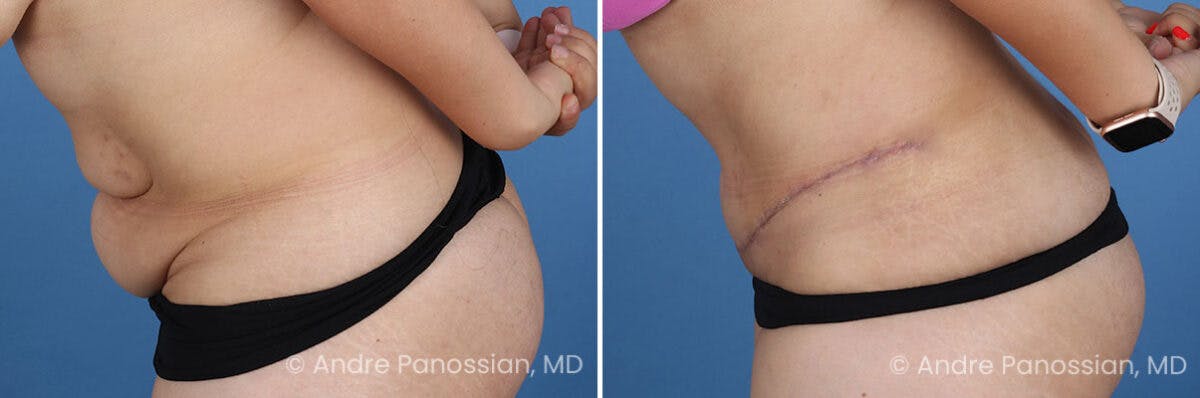 Tummy Tuck Before & After Gallery - Patient 319524 - Image 7