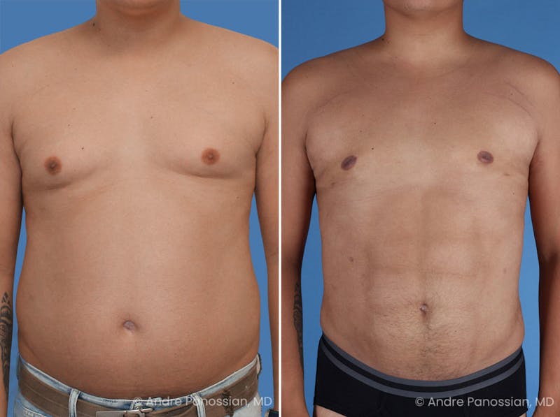 Abdominal High-Definition Liposuction Before & After Gallery - Patient 495730 - Image 1
