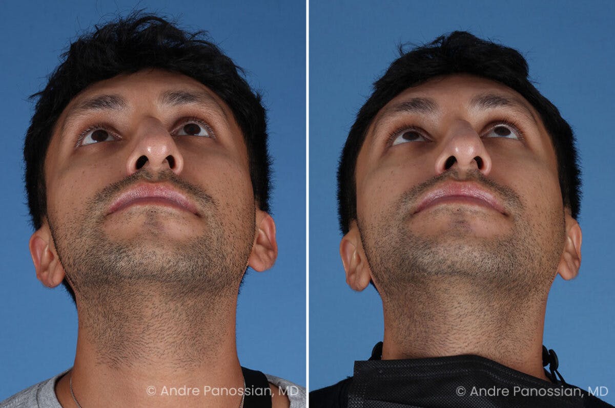 Ear Pinning (Otoplasty) Before & After Gallery - Patient 209648 - Image 6