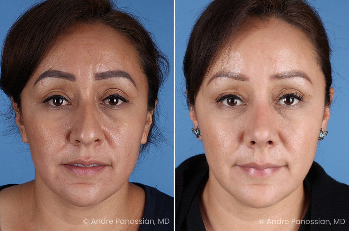 Rhinoplasty Before & After Gallery - Patient 401519 - Image 2