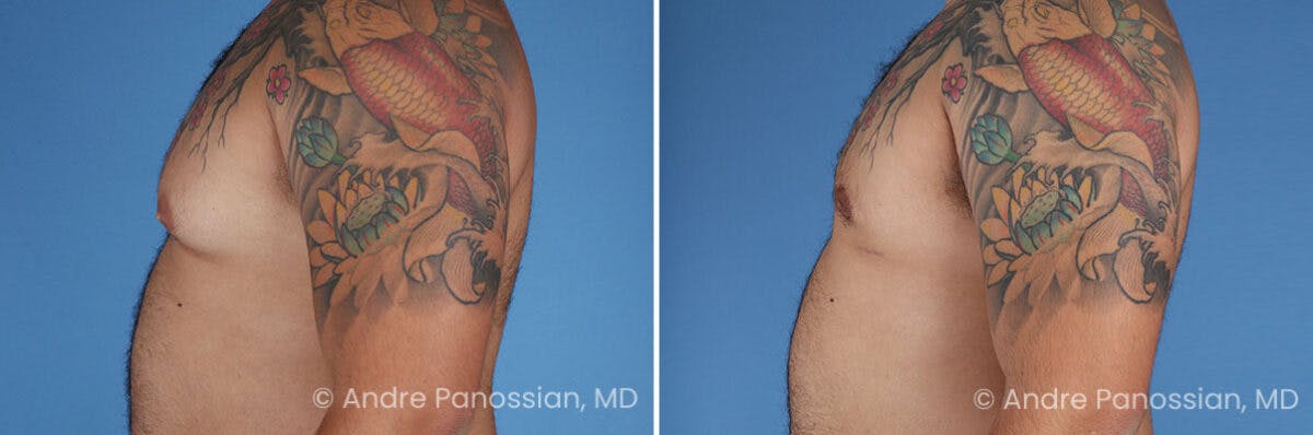 Male Breast Reduction (Gynecomastia) Before & After Gallery - Patient 211270 - Image 4