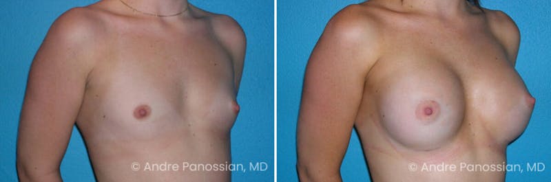 Breast Augmentation Before & After Gallery - Patient 275371 - Image 1