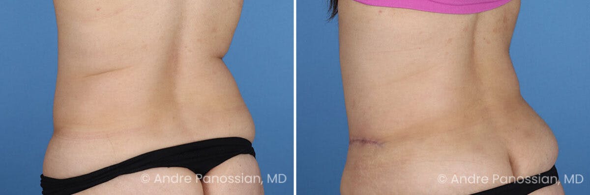 Tummy Tuck Before & After Gallery - Patient 319524 - Image 8