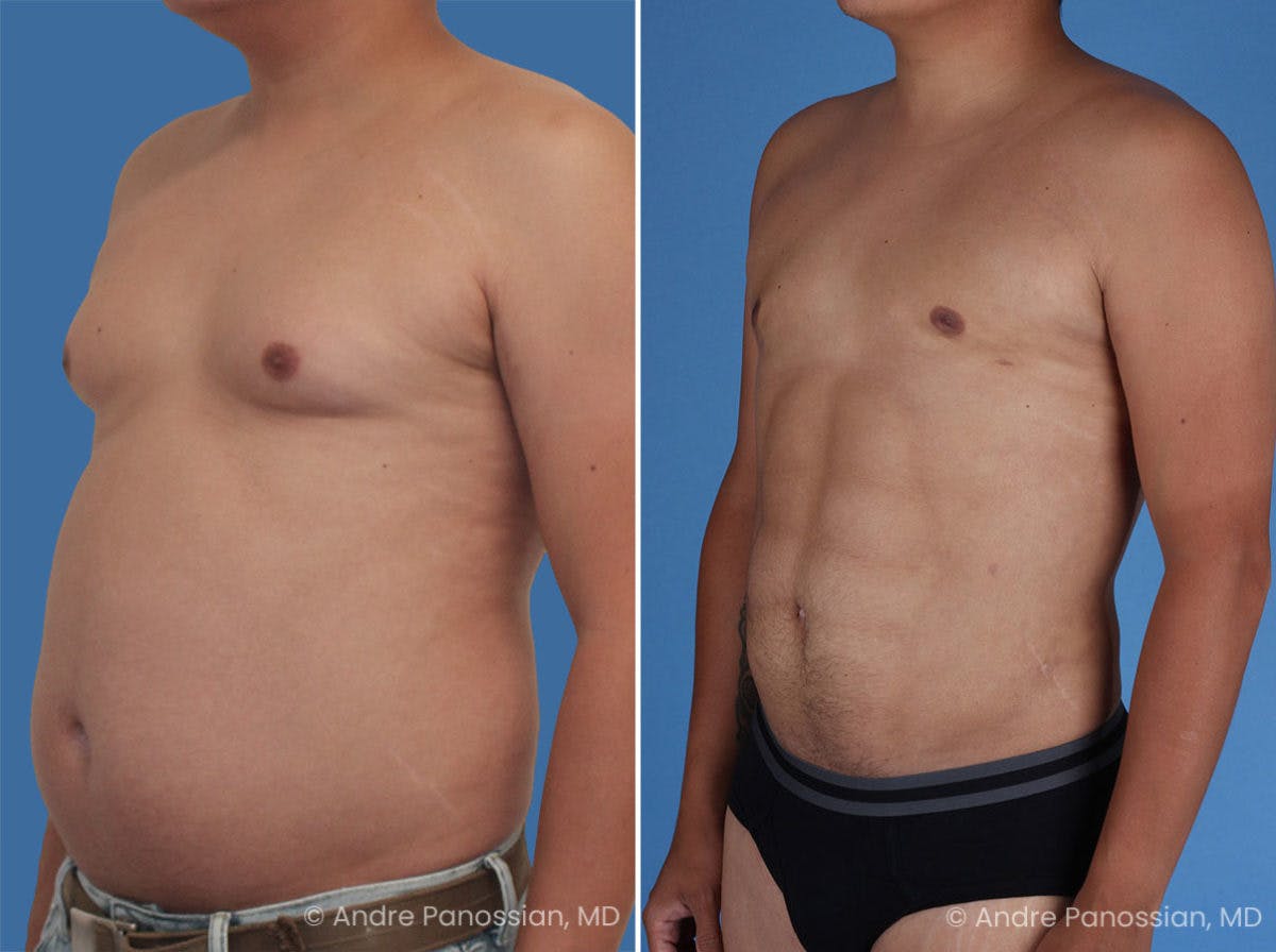 Abdominal High-Definition Liposuction Before & After Gallery - Patient 495730 - Image 2