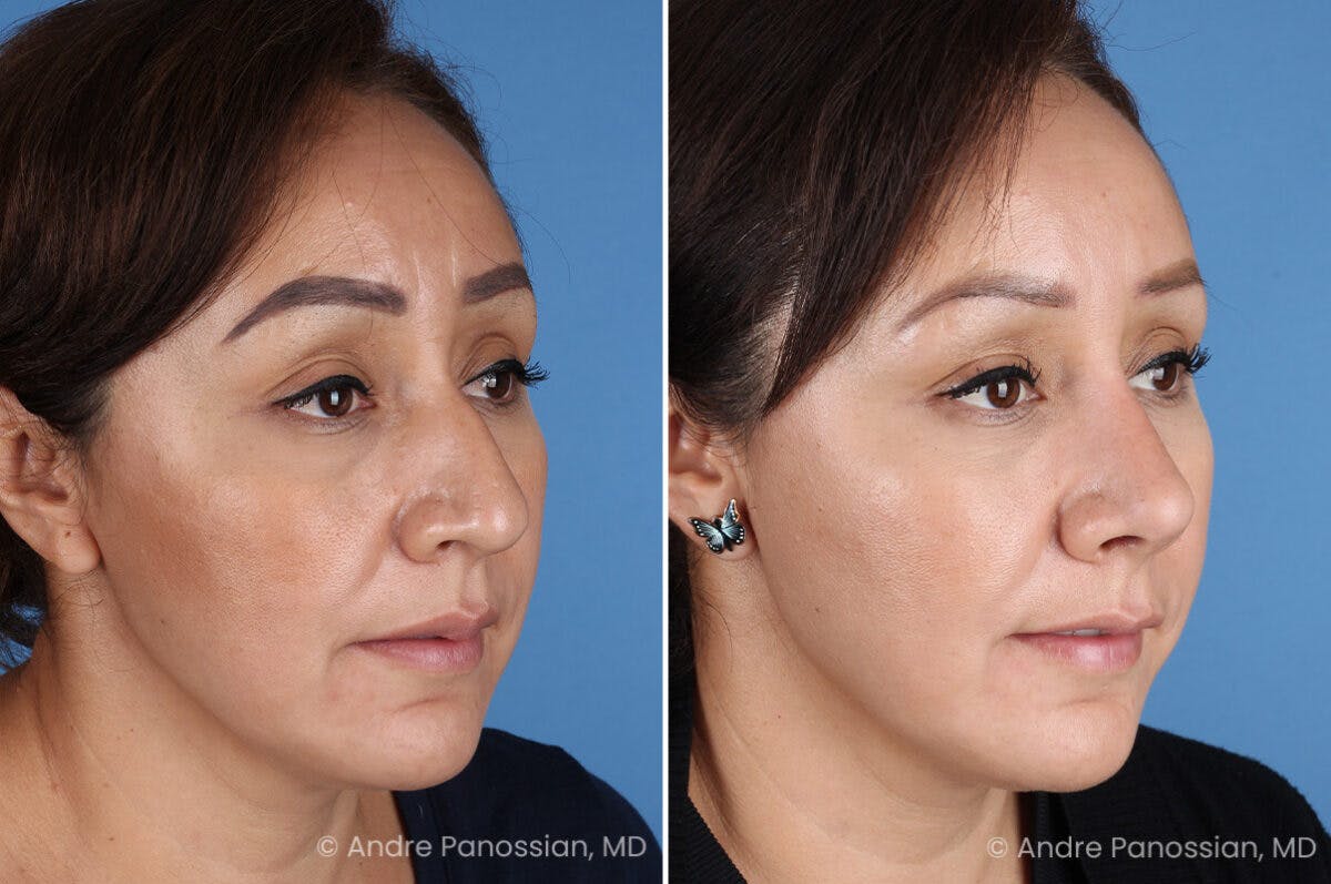 Rhinoplasty Before & After Gallery - Patient 401519 - Image 3