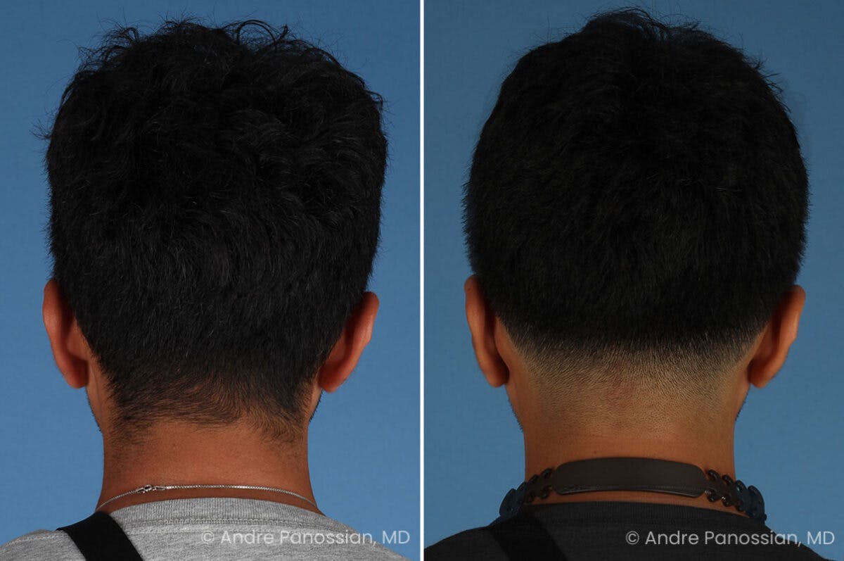 Ear Pinning (Otoplasty) Before & After Gallery - Patient 209648 - Image 7