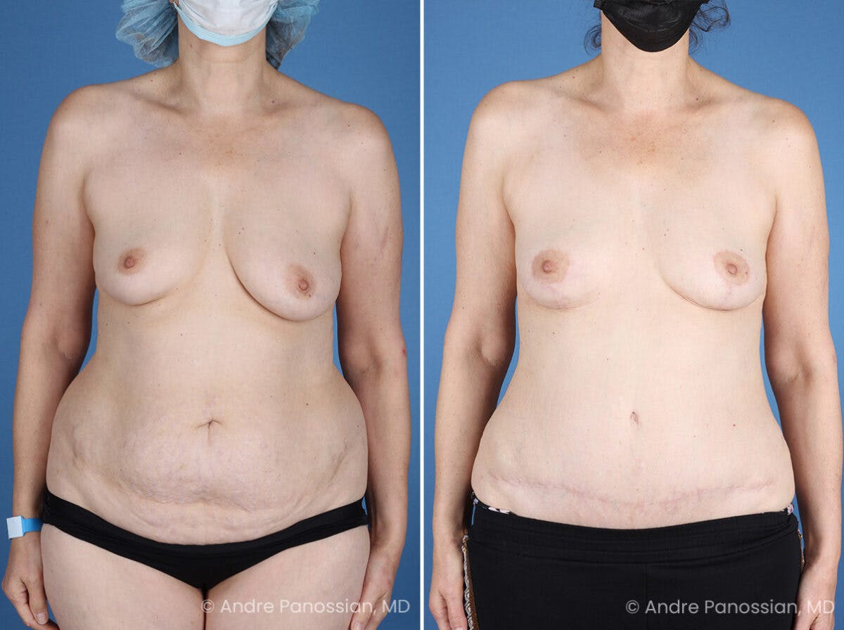 Mommy Makeover Before & After Gallery - Patient 739873 - Image 1