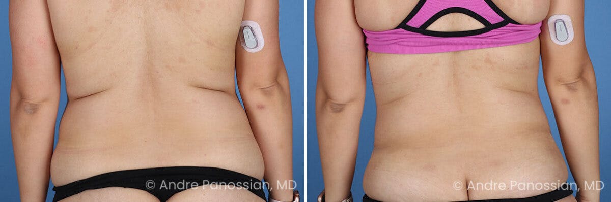 Tummy Tuck Before & After Gallery - Patient 319524 - Image 9
