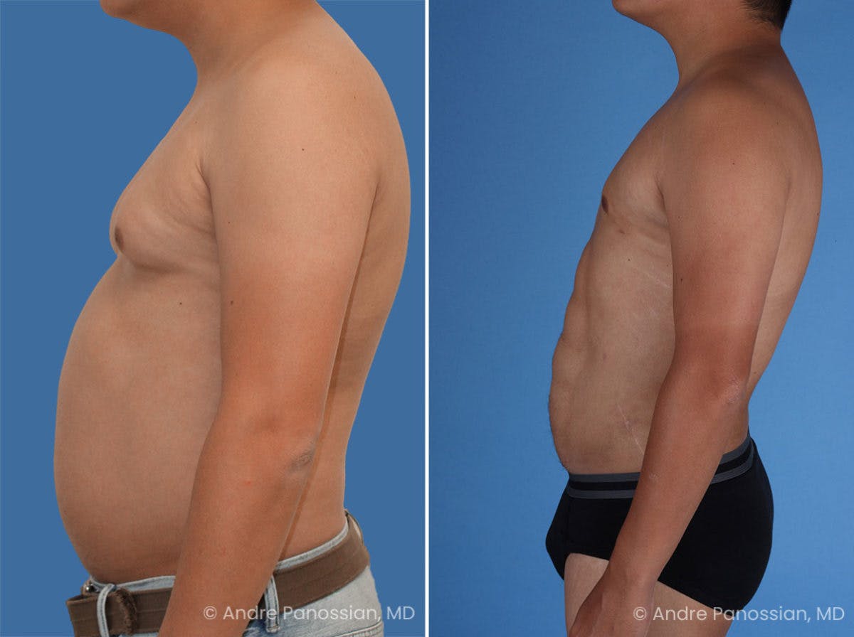 Abdominal High-Definition Liposuction Before & After Gallery - Patient 495730 - Image 3