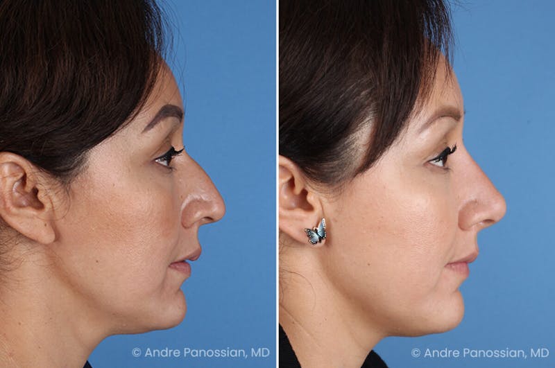 Rhinoplasty Before & After Gallery - Patient 401519 - Image 1