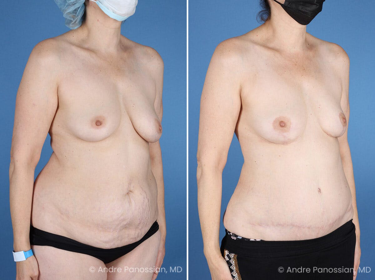 Mommy Makeover Before & After Gallery - Patient 739873 - Image 2