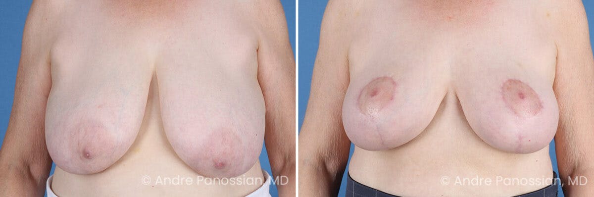 Breast Lift/Reduction Before & After Gallery - Patient 128292 - Image 1