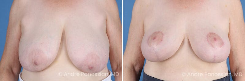 Breast Lift/Reduction Before & After Gallery - Patient 128292 - Image 1
