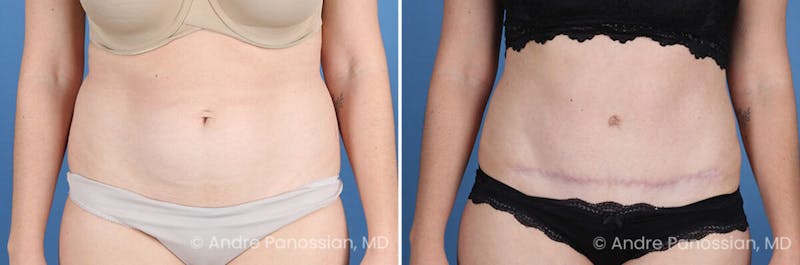 Tummy Tuck Before & After Gallery - Patient 240231 - Image 1