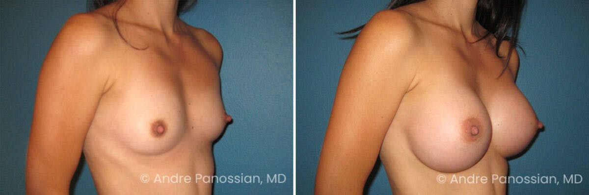Breast Augmentation Before & After Gallery - Patient 335328 - Image 1