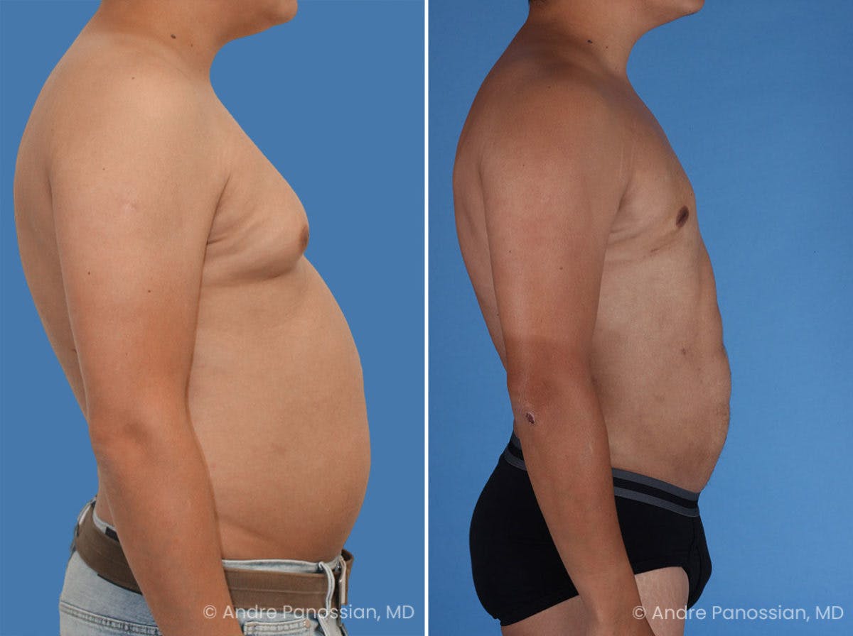 Abdominal High-Definition Liposuction Before & After Gallery - Patient 495730 - Image 4