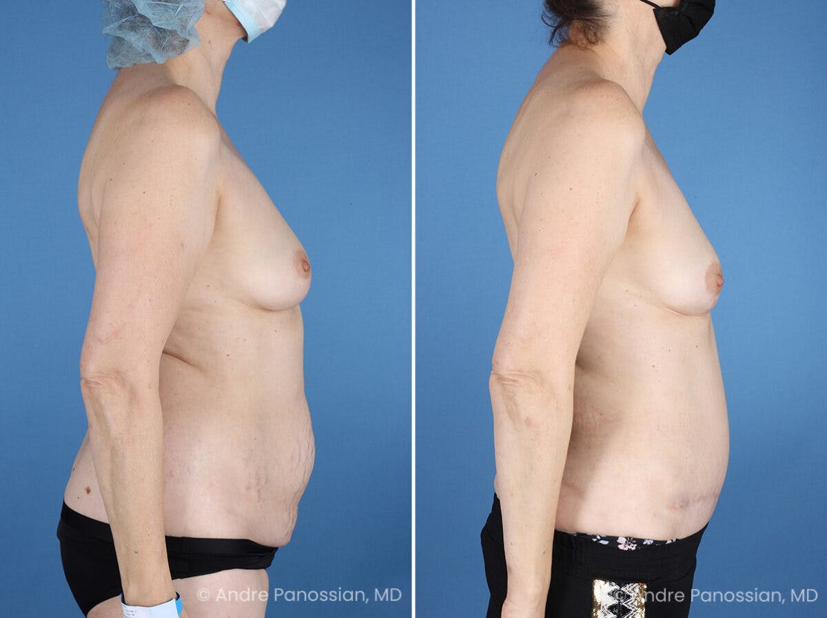 Mommy Makeover Before & After Gallery - Patient 739873 - Image 3