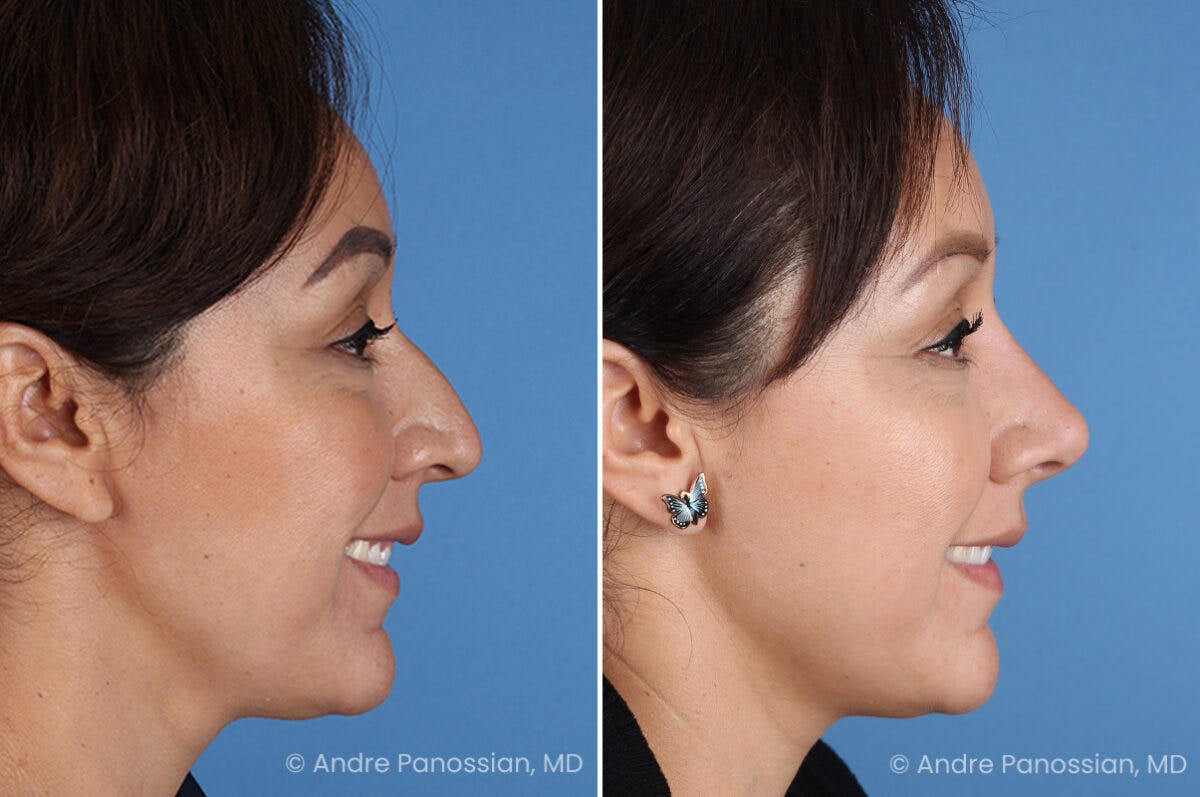 Rhinoplasty Before & After Gallery - Patient 401519 - Image 4