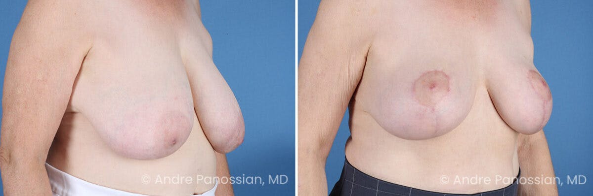 Breast Lift/Reduction Before & After Gallery - Patient 128292 - Image 2