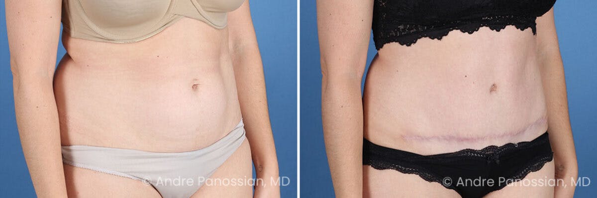 Tummy Tuck Before & After Gallery - Patient 240231 - Image 2