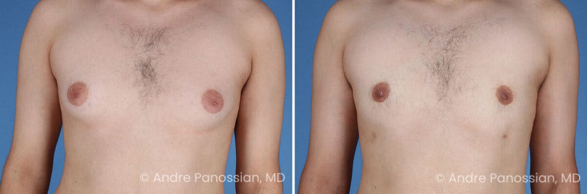 Male Breast Reduction (Gynecomastia) Before & After Gallery - Patient 351347 - Image 1