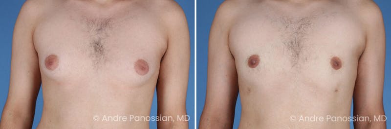 Male Breast Reduction (Gynecomastia) Before & After Gallery - Patient 351347 - Image 1