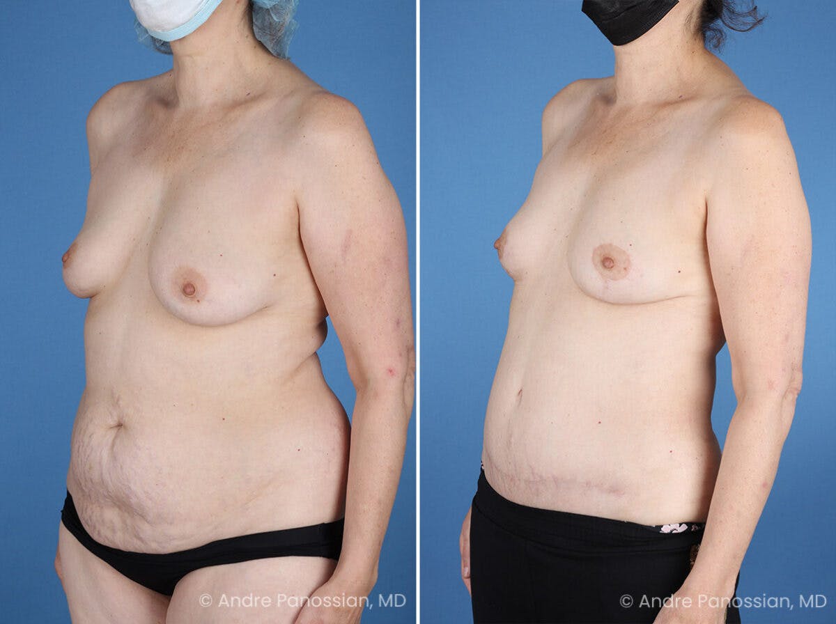 Mommy Makeover Before & After Gallery - Patient 739873 - Image 4