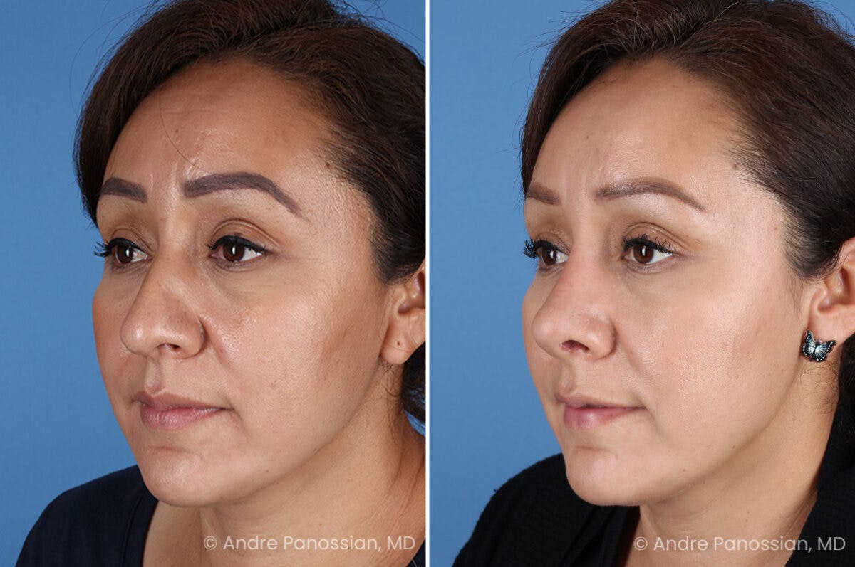 Rhinoplasty Before & After Gallery - Patient 401519 - Image 5