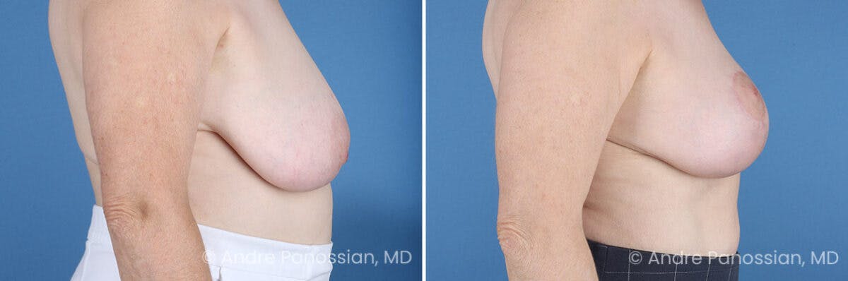 Breast Lift/Reduction Before & After Gallery - Patient 128292 - Image 3