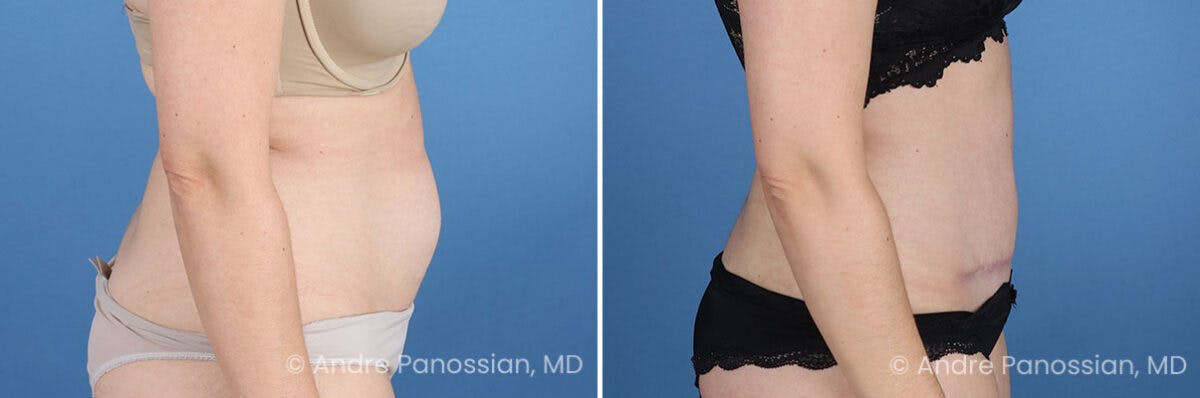 Tummy Tuck Before & After Gallery - Patient 240231 - Image 3