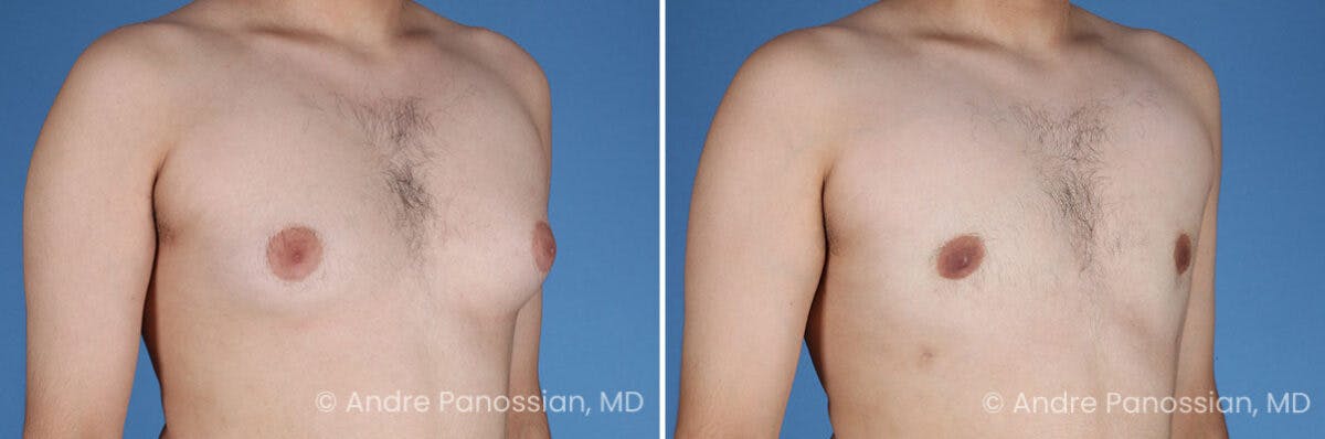 Male Breast Reduction (Gynecomastia) Before & After Gallery - Patient 351347 - Image 2