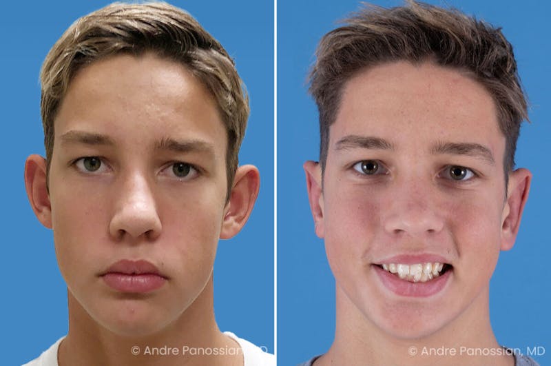 Ear Pinning (Otoplasty) Before & After Gallery - Patient 100215 - Image 1