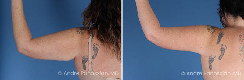 Upper Arm Lift Before & After Gallery - Patient 891146 - Image 1