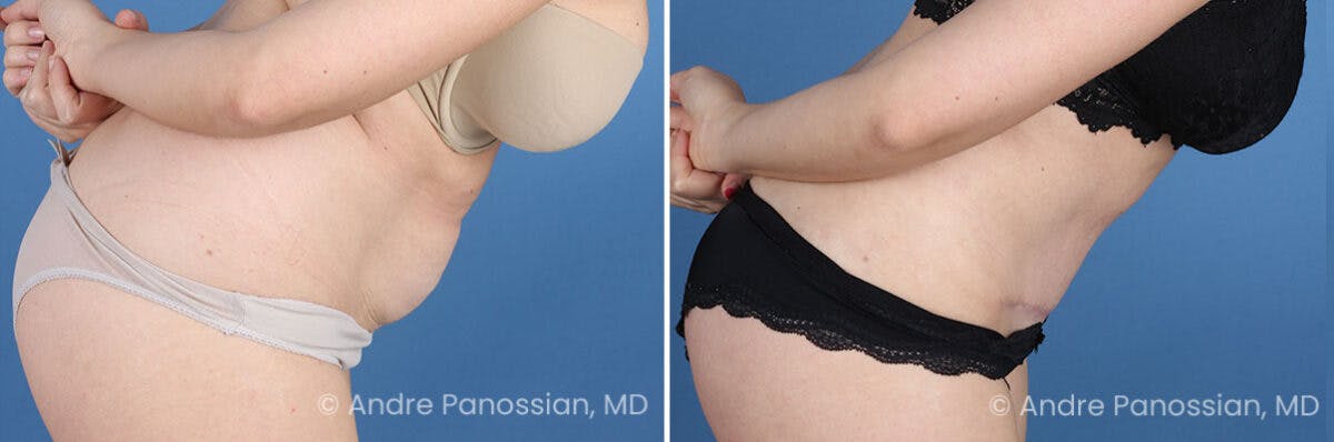 Tummy Tuck Before & After Gallery - Patient 240231 - Image 4