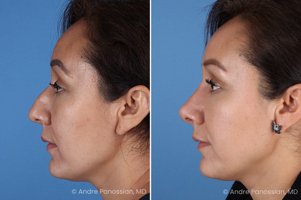 Rhinoplasty Before & After Gallery - Patient 401519 - Image 6