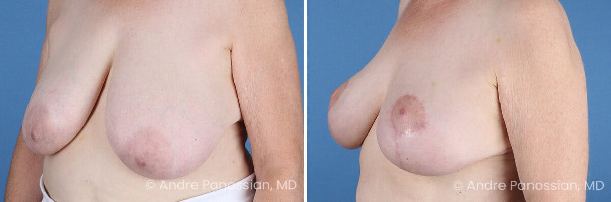 Breast Lift/Reduction Before & After Gallery - Patient 128292 - Image 4