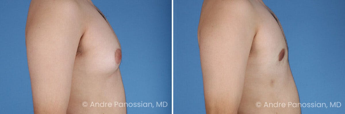Male Breast Reduction (Gynecomastia) Before & After Gallery - Patient 351347 - Image 3