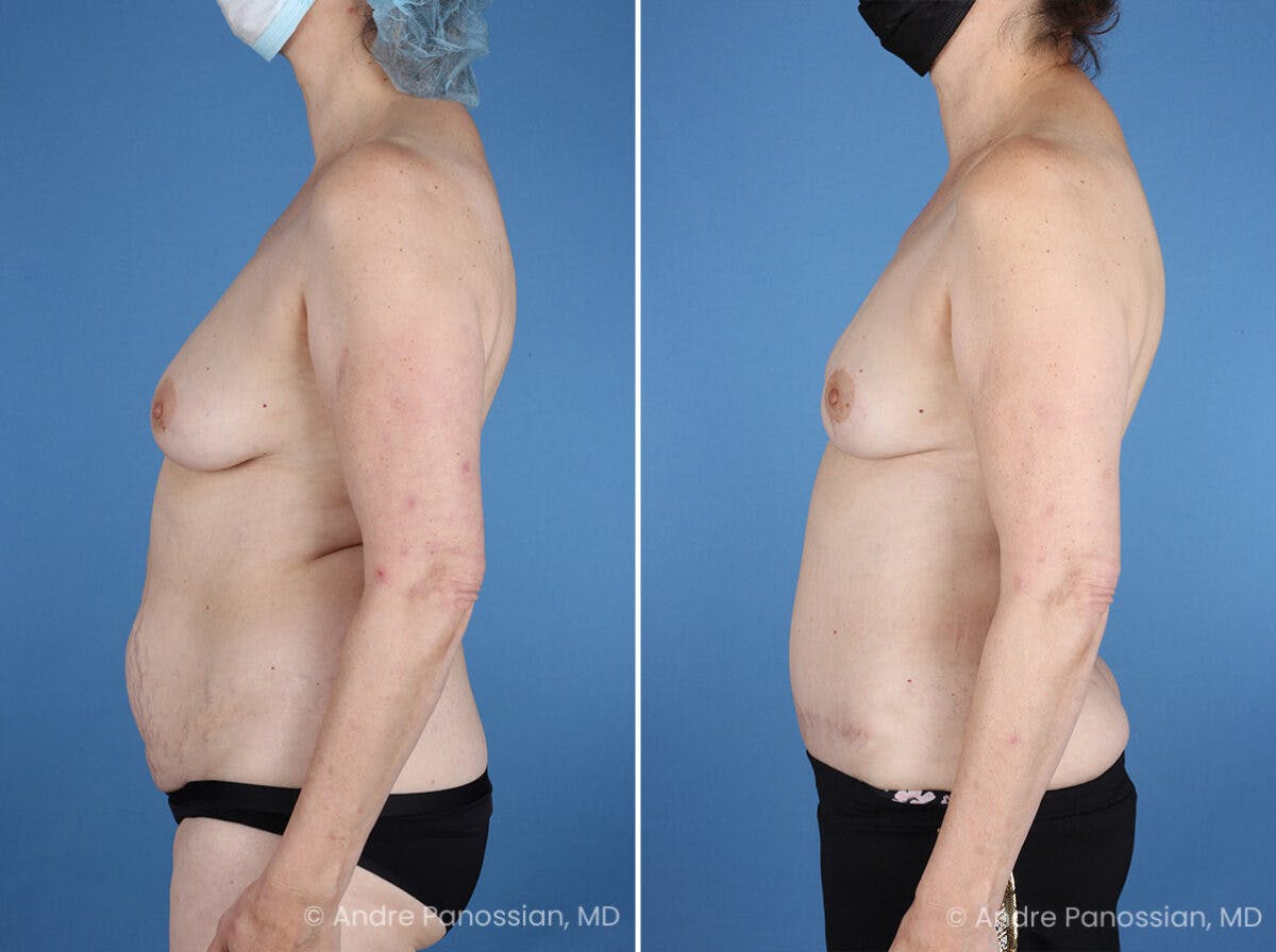 Mommy Makeover Before & After Gallery - Patient 739873 - Image 5