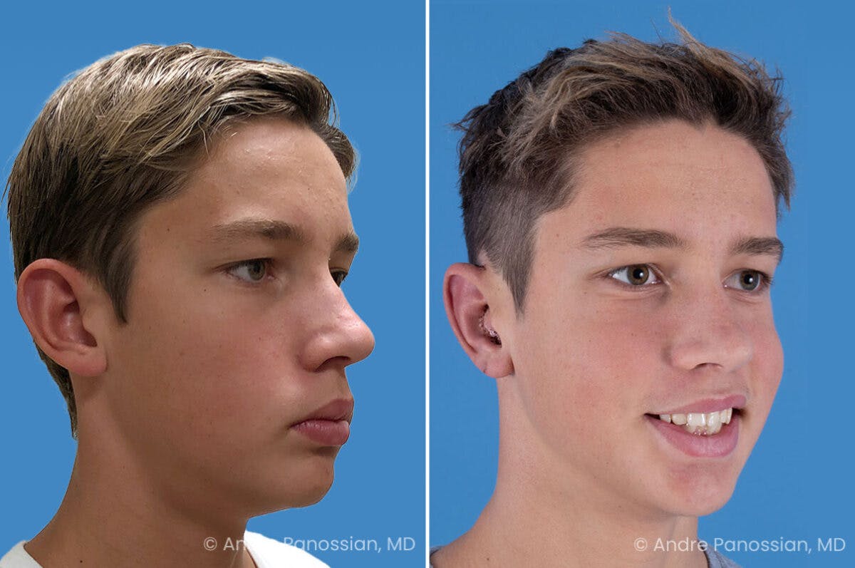 Ear Pinning (Otoplasty) Before & After Gallery - Patient 100215 - Image 2
