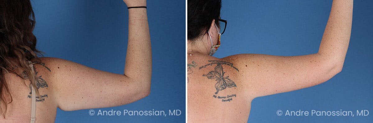 Upper Arm Lift Before & After Gallery - Patient 891146 - Image 2